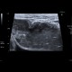 Ileus, small bowel obstruction, SBO: US - Ultrasound